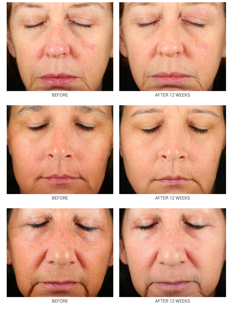 Medical-Grade Retinoid Serum 2.5% & 5% | Advanced Anti-Aging Treatment WRI-LAX 5x
